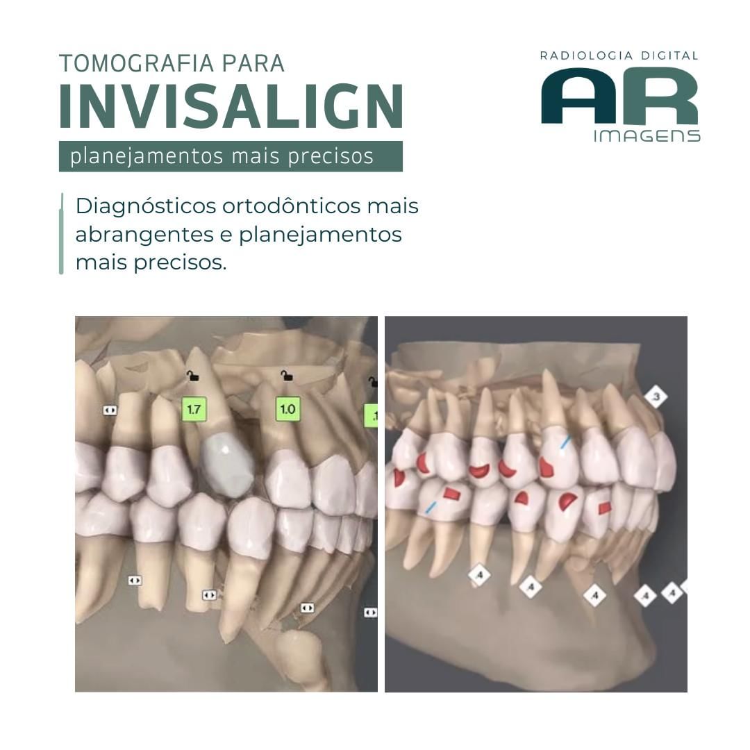 tomografia-para-invisalign