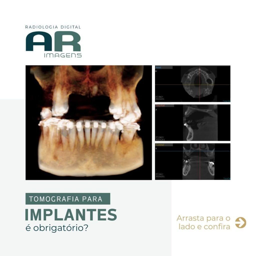 tomografia-para-implantes