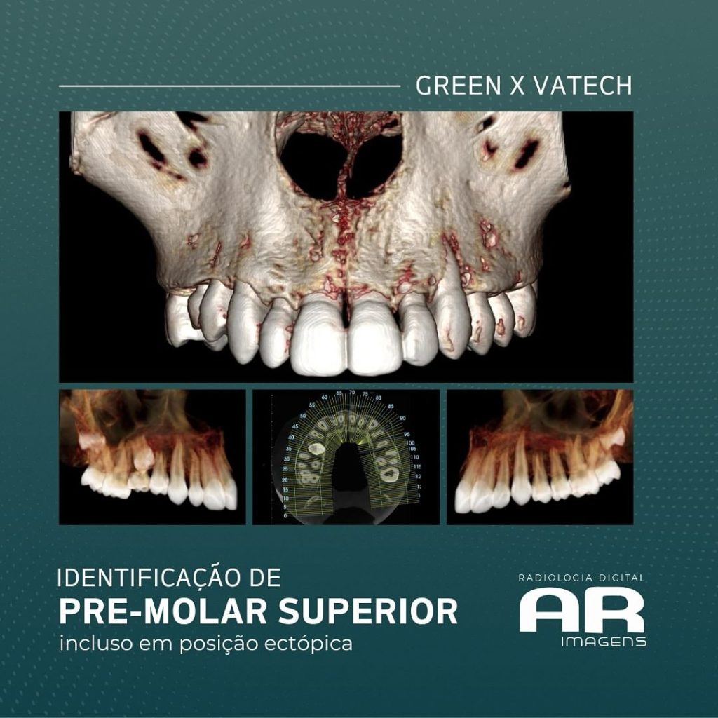 identificacao-de-pre-molar-superior