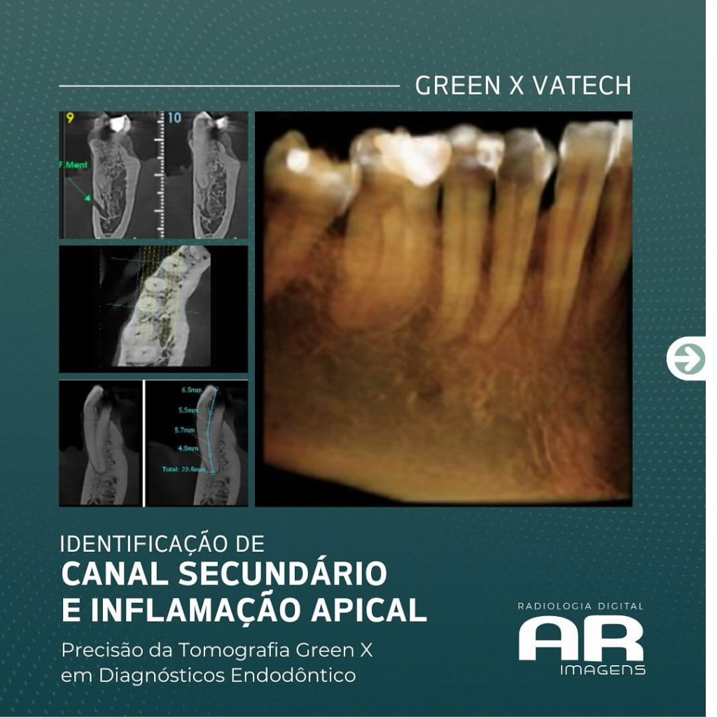 canal-secundario-e-inflamacao-apical