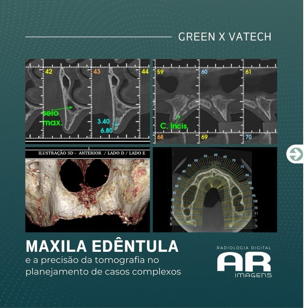 maxila-edentula