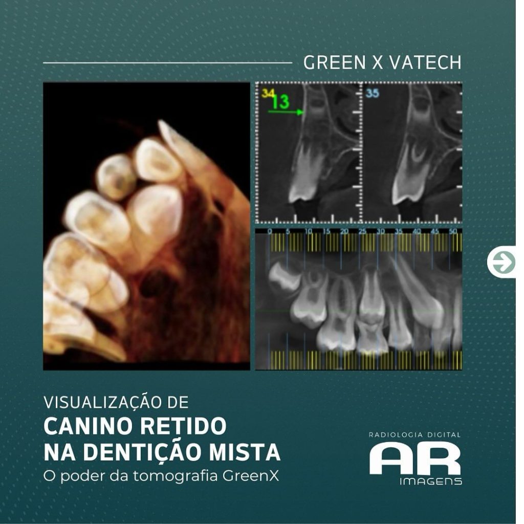 visualizacao-de-canino-retido-na-denticao-mista