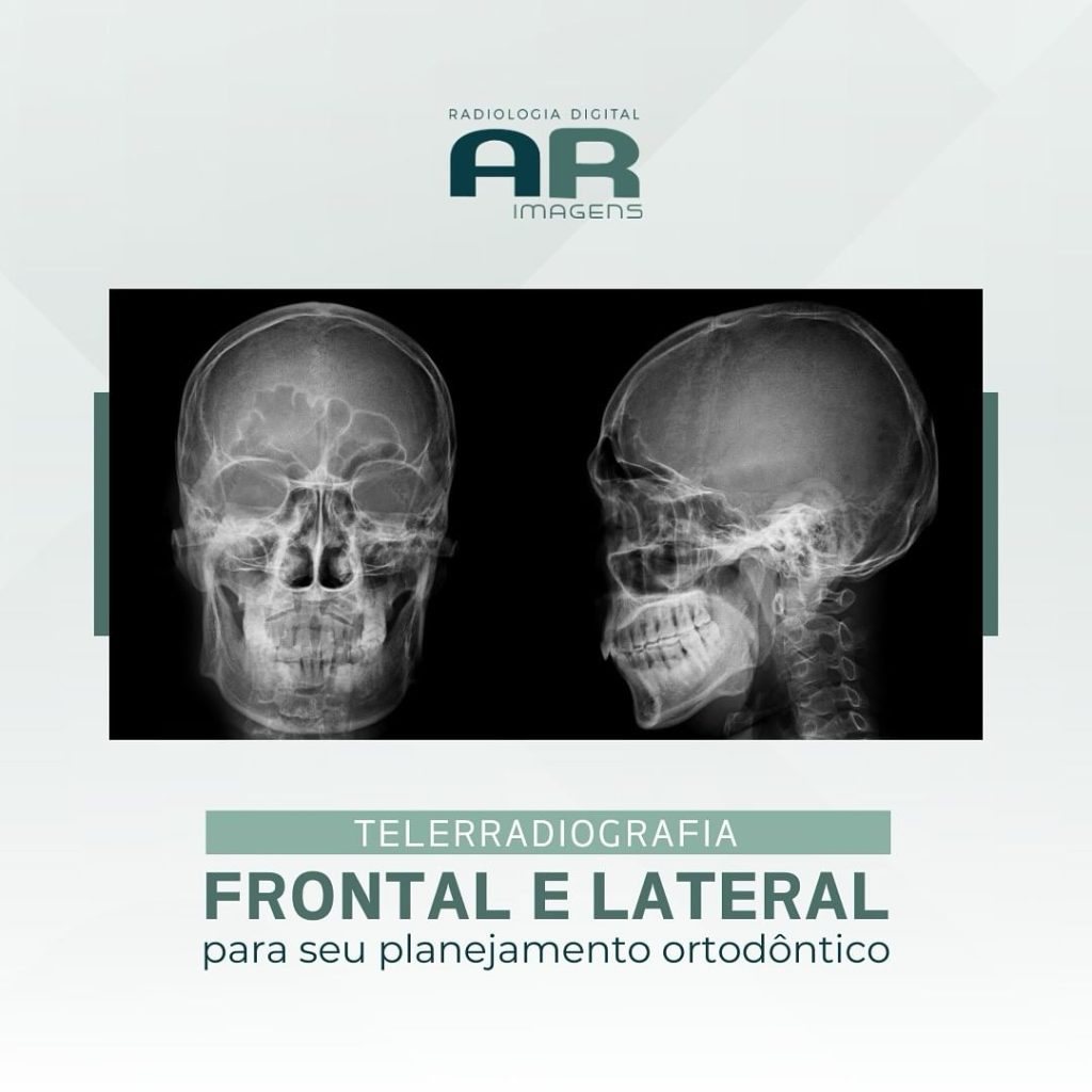 telerradiografia-frontal-e-lateral