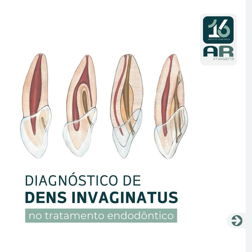 diagnostico-de-dens-invaginatus