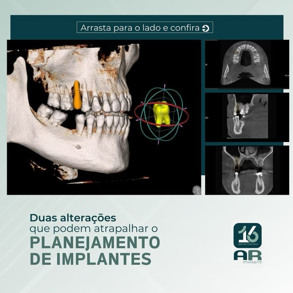 planejamento-de-implantes