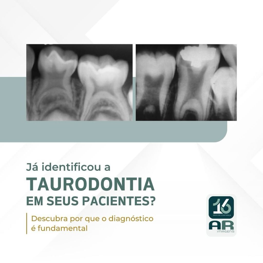 ja-identificou-a-taurodontia-em-seus-pacientes-?