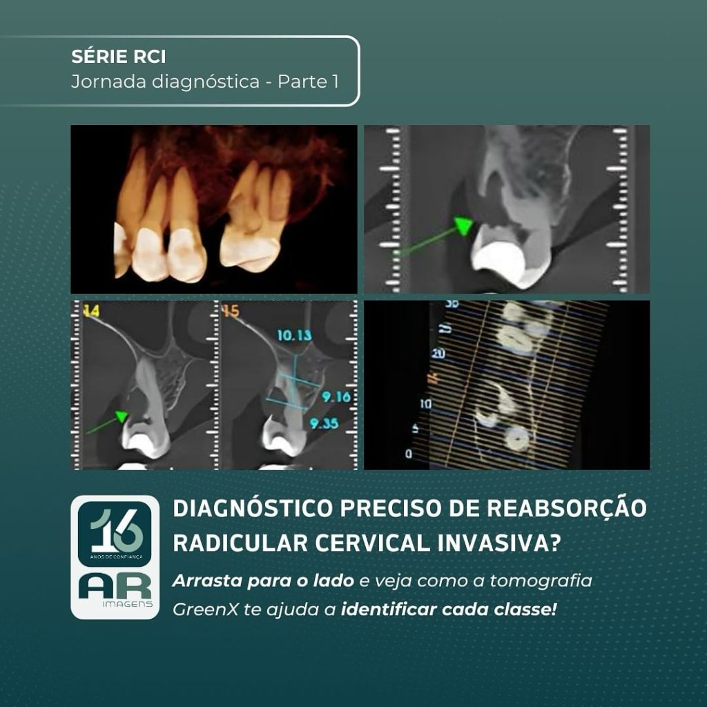 diagnostico-preciso-de-rci