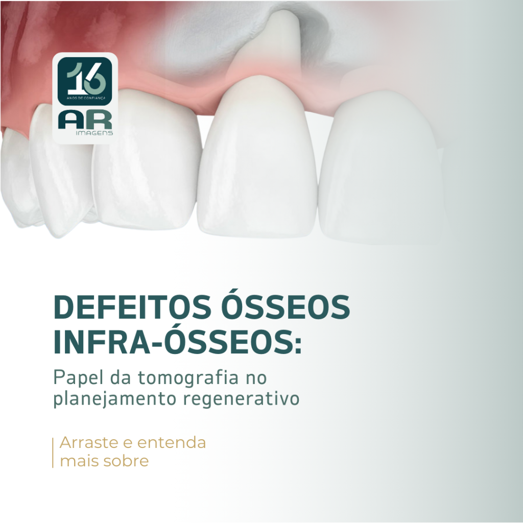 defeitos-osseos-infra-osseos